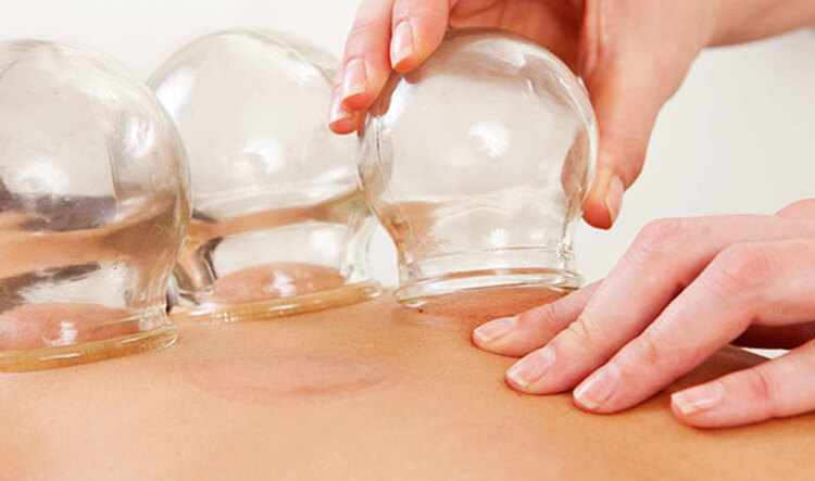 Cupping & Hijama - Séances à Bruxelles