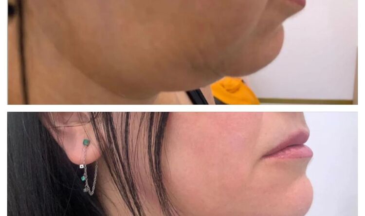  Mésothérapie capillaire