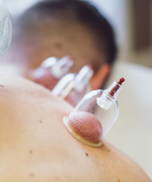Hijama ou Cupping